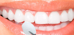 veneers1 mini