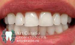 Зубы после отбеливания