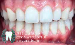 Зубы после снятия зубного камня, исправления формы и реставрации