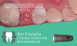 Зубы до установки импланта