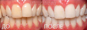 отбеливание зубов до и после