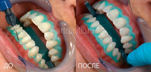 opalescence отбеливание зубов до и после