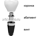 implant all