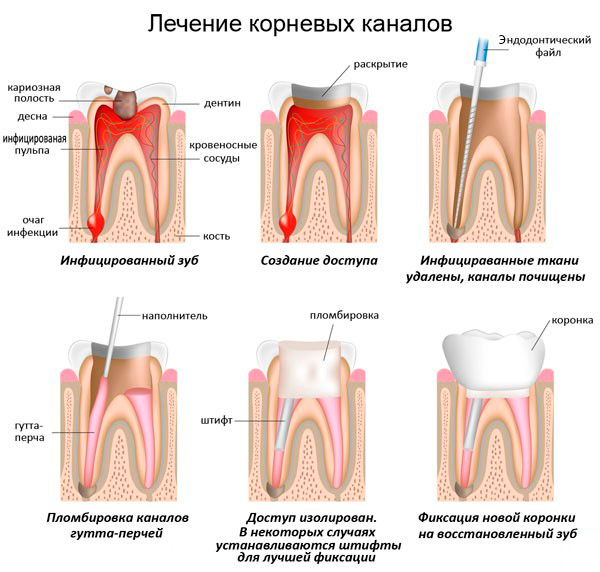 lechenie kanalov