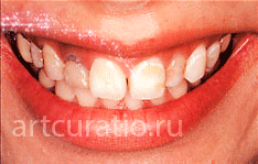 veneer